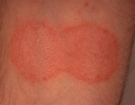 Mycosis Fungoides Pictures Staging Symptoms Treatment And Causes