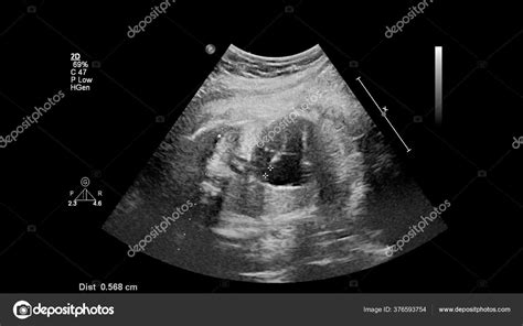 Ultrasound Examination Fetal Heart Hypoplastic Left Heart Syndrome