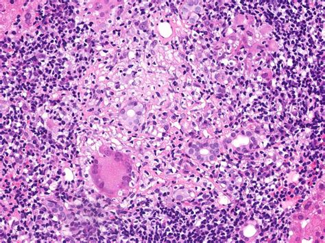 Pathology Outlines Granulomatous Hepatitis