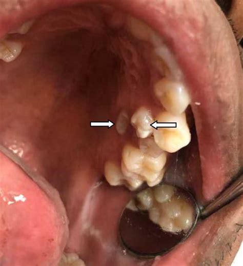 Polydent Multiple Supplemental And Impacted Teeth A Non Syndromic