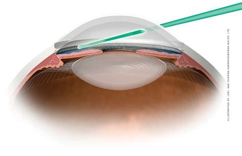 Cataract Surgery Applecross Eye Clinic