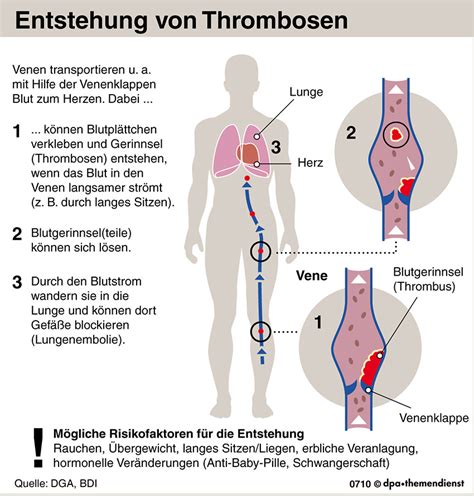 Als thrombose wird eine intravasale (innerhalb der blutgefäße) blutgerinnung im lebenden organismus bezeichnet. Gefährlicher Pfropf: Auf Reisen einer Thrombose vorbeugen ...