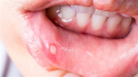 Here S What S Really Causing Your Canker Sores