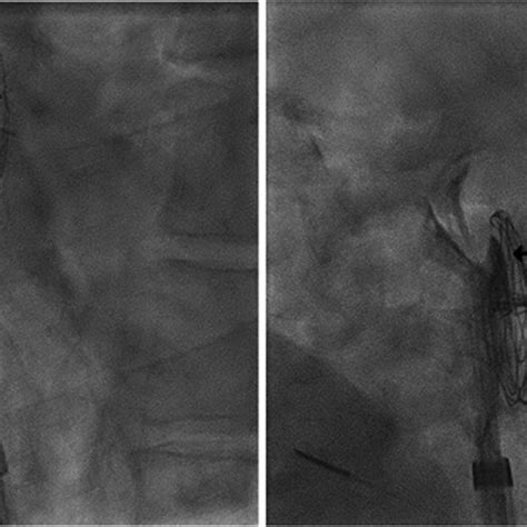 Fluoroscopy During Cardiac Catheterization Shows Noblestitch™ El Needle