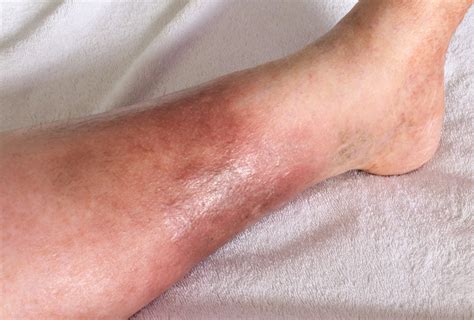 Cellulitis Home Treatment To Relieve Your Skin Of Pain And Swelling