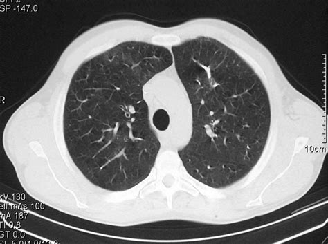 La trombosis venosa profunda y la embolia pulmonar (tvp y ep) son afecciones que no se diagnostican con frecuencia y son graves, pero se pueden prevenir. Embolia pulmonar masiva después de esclerosis endoscópica ...