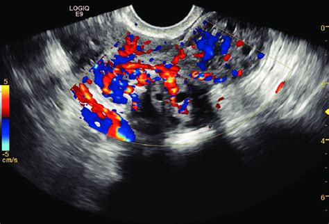 Transvaginal Image Of An Irregular Cystic Solid Adnexal Mass With Rich