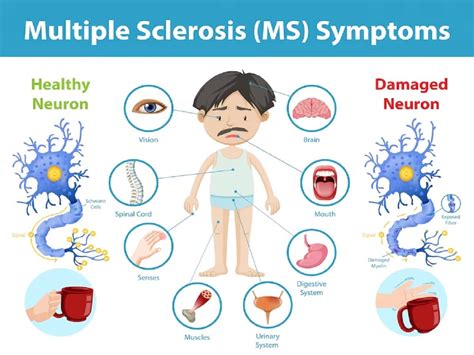 Multiple Sclerosis Double Vision And Other Warning Signs In The Eyes