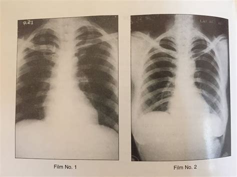 Maybe you would like to learn more about one of these? medical school: NORMAL VARIANT OF CHEST XRAY | X ray, Chest, Radiography