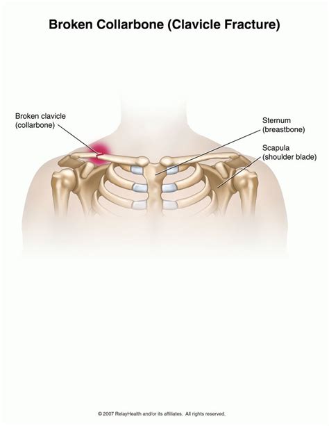 Soft Painless Lump On Collarbone Yellowpitch
