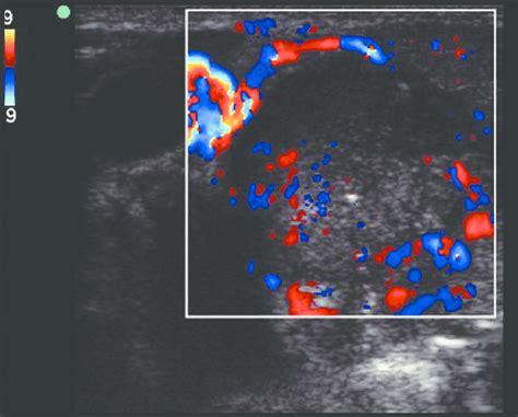 Color Doppler Ultrasound Image Of Malignant Lymph Node Showing