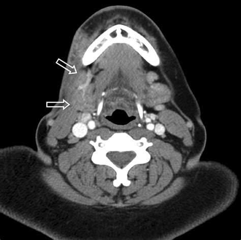 Ct Imaging Of Head And Neck Lupus Panniculitis American Journal Of