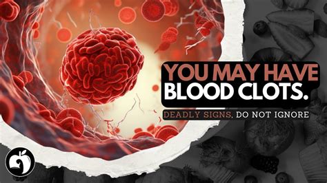 Warning Signs Of Blood Clots Top 5 Dangerous Signs Youtube