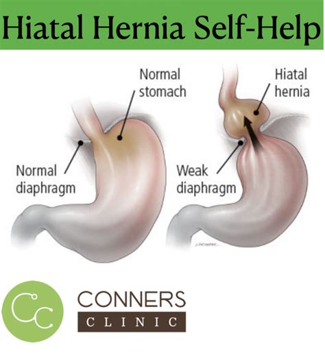 Hiatal Hernia Self HelpConners Clinic Alternative Cancer Coaching