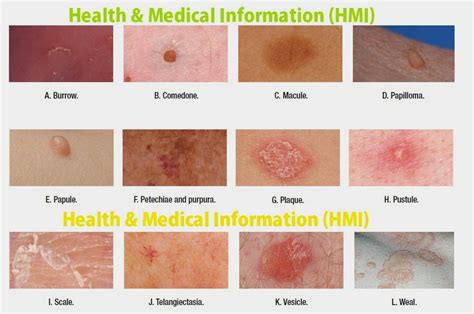 Health And Medical Information Hmi Terms Used To Describe Skin Lesions