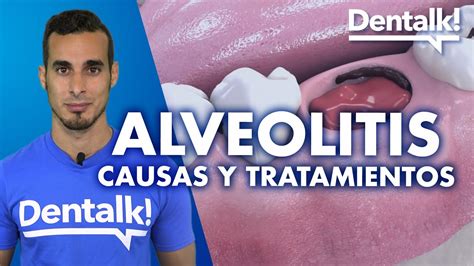 InfecciÓn Tras Extracción Dental Alveolitis Tratamiento Síntomas Y