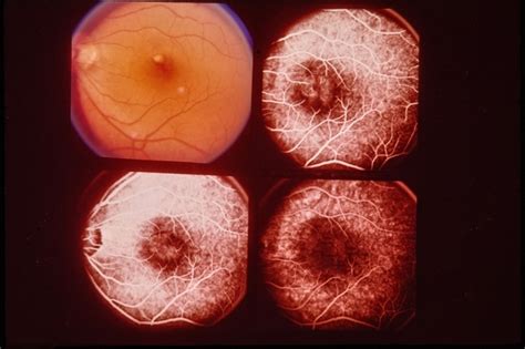 Central Serous Retinopathy Retina Image Bank