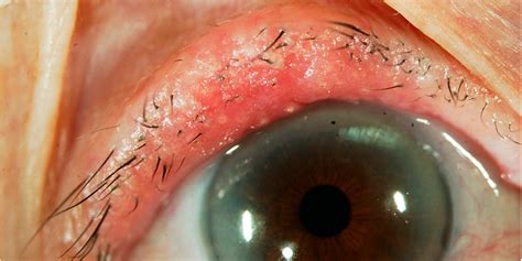 Skin Cancer On Eyelid Symptoms
