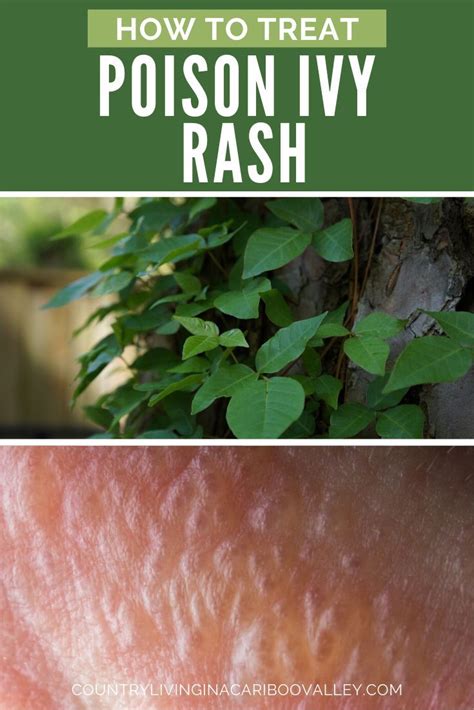 How To Treat Poison Ivy Rash Near Eye
