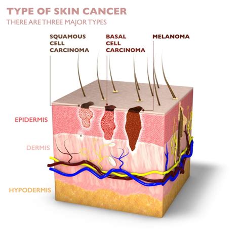 Eczema Specialists In Los Angeles And Encino Ca Bhskin