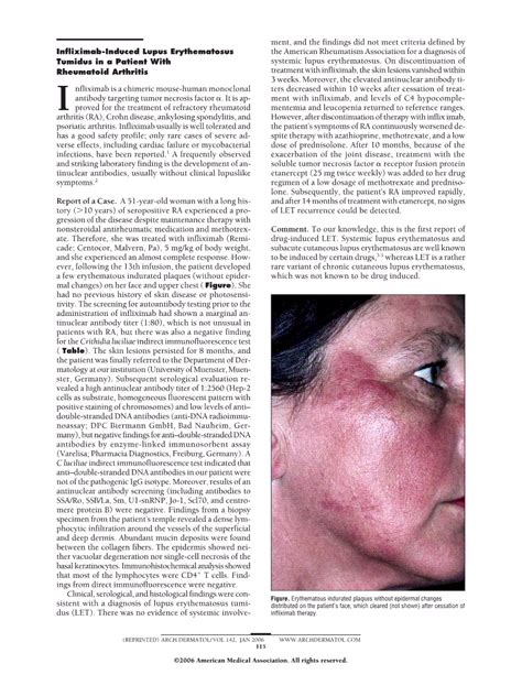 Infliximab Induced Lupus Erythematosus Tumidus In A Patient With