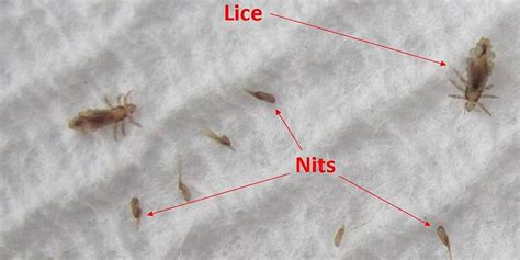 How To Check For Lice Eggs Or Nits