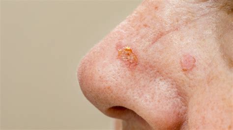 Types Of Skin Lesions Skin Lesions Symptoms Causes And Treatment