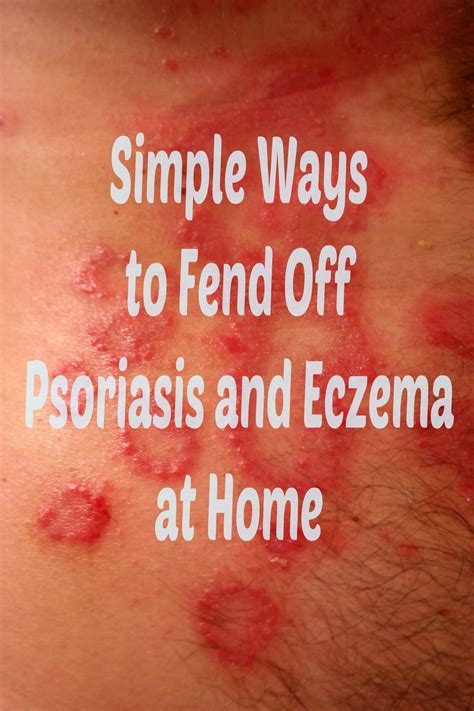 How To Treat Eczema And Psoriasis Naturally Skin Skindisease