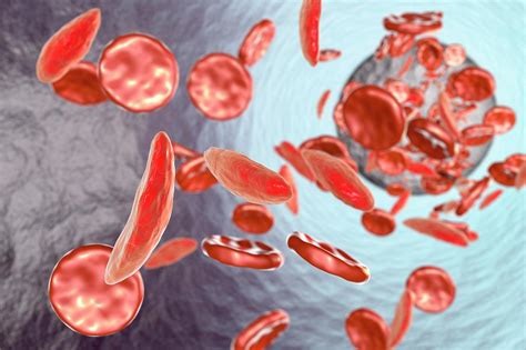 Sickle Cell Anaemia Photograph By Kateryna Konscience Photo Library