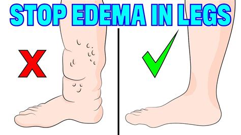 How To Naturally Reverse Edema Swelling In Your Legs Youtube