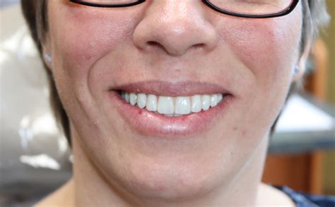 Dental Implants In Buffalo Ny Southtowns Dental