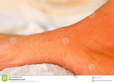 Bed Bug Bites On A Foot Stock Photo Image Of Insect 27214516