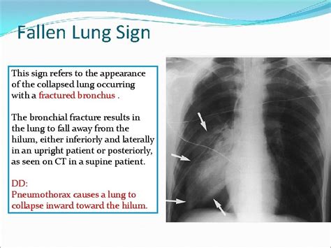 Radiological Signs Of Chest Disorders Part 1 By