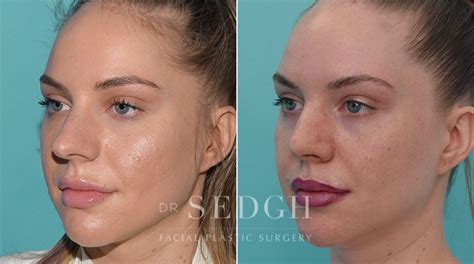 Crooked Nose Surgery Before And After Photos Dr Sedgh