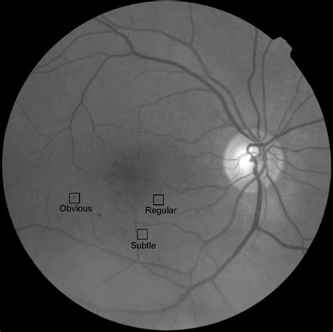 Figure 2 From Improving Microaneurysm Detection In Color Fundus Images