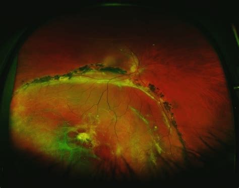 Chronic Inferior Retinal Detachment Retina Image Bank