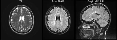 How To Read Mri Of Brain