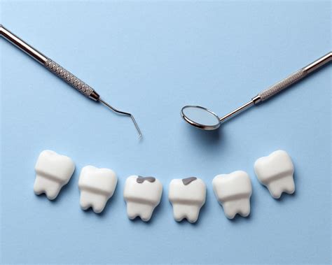 Tooth Coloured White Fillings Govan Dental Care