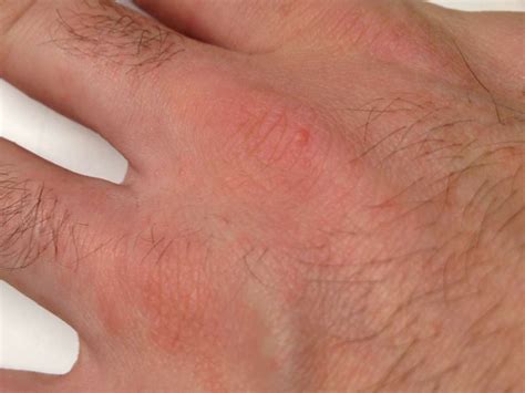 Pictures Of Scabies On Hands Picturemeta