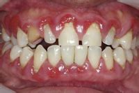 Gratis frakt rett hjem i din postkasse. Parodontitis Gingivitis Problem Zahnfleisch Probleme ...