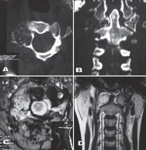 Axial Ct Images Showing A Lesion Of The Right Lateral Mass Of C1
