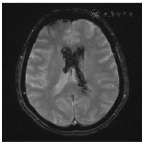 Reversible Cerebral Vasoconstriction Syndrome Presenting As An Isolated