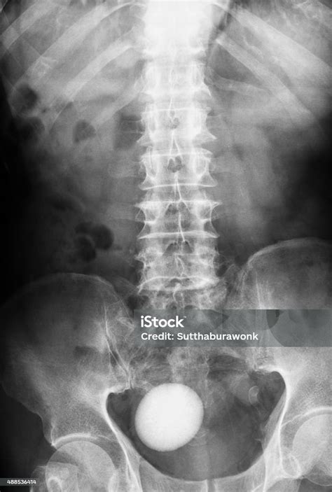 Xray Image Of Plan Kub Supine View Stock Photo Download Image Now