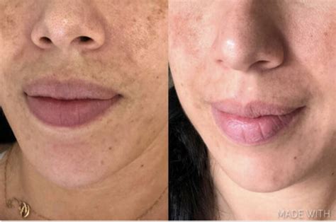 The Peel Connection® Offers At Home Chemical Peels