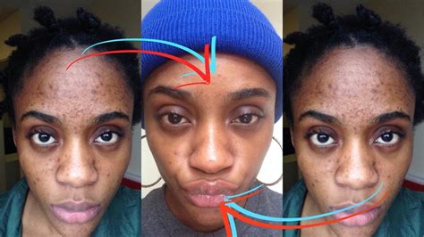 How I Got Rid Of Dark Scars Hyperpigmentation And Acne Youtube