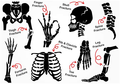 Set Bone Fracture Icon ( Pelvic , Hip , Thigh ( femur ) , Hand , Wrist ...