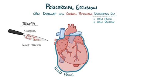 Osmosis Pericardial Tamponade What Is It Causes Pericardial Porn Sex Picture