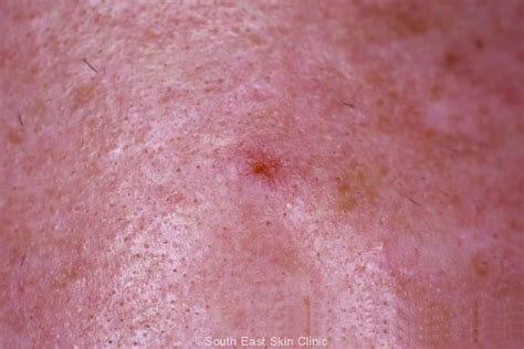 Scc Squamous Cell Carcinoma South East Skin Clinic