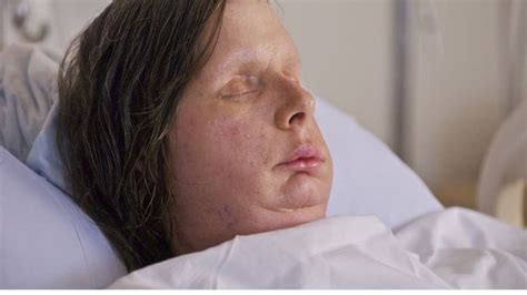 Woman Who Had Face Transplant Following Chimp Attack Opens Up In
