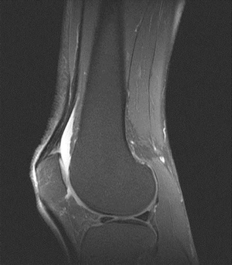 Mri Of The Knee Showing Joint Effusion Download Scientific Diagram
